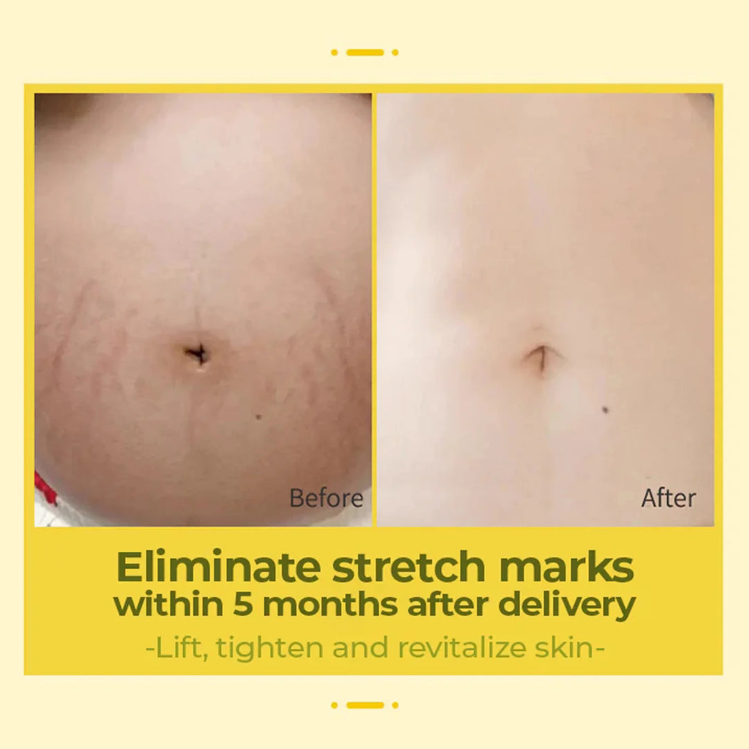 EELHOE Olive Smoothing Oil – Stretch Mark & Scar Repair Massage Oil