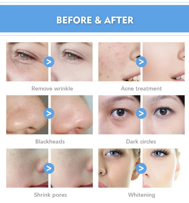 Smart Ice Blue 7-in-1 HydraFacial System – AI-Powered Skin Rejuvenation