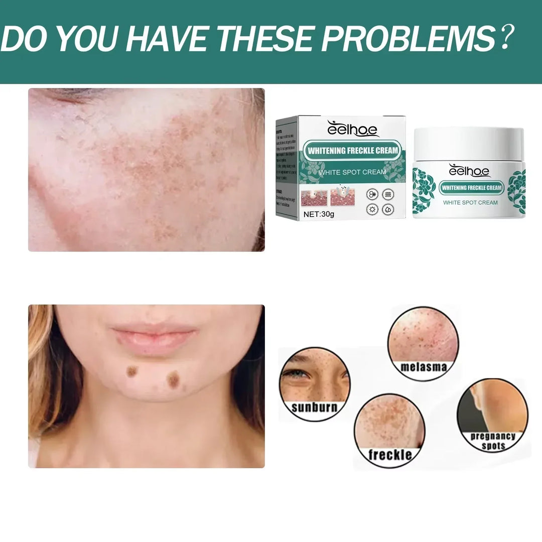 EELHOE Niacinamide Melasma Brightening Cream – Fade Freckles, Dark Spots & Uneven Tone