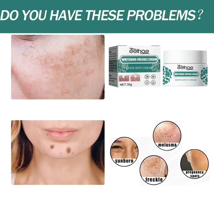 EELHOE Niacinamide Melasma Brightening Cream – Fade Freckles, Dark Spots & Uneven Tone