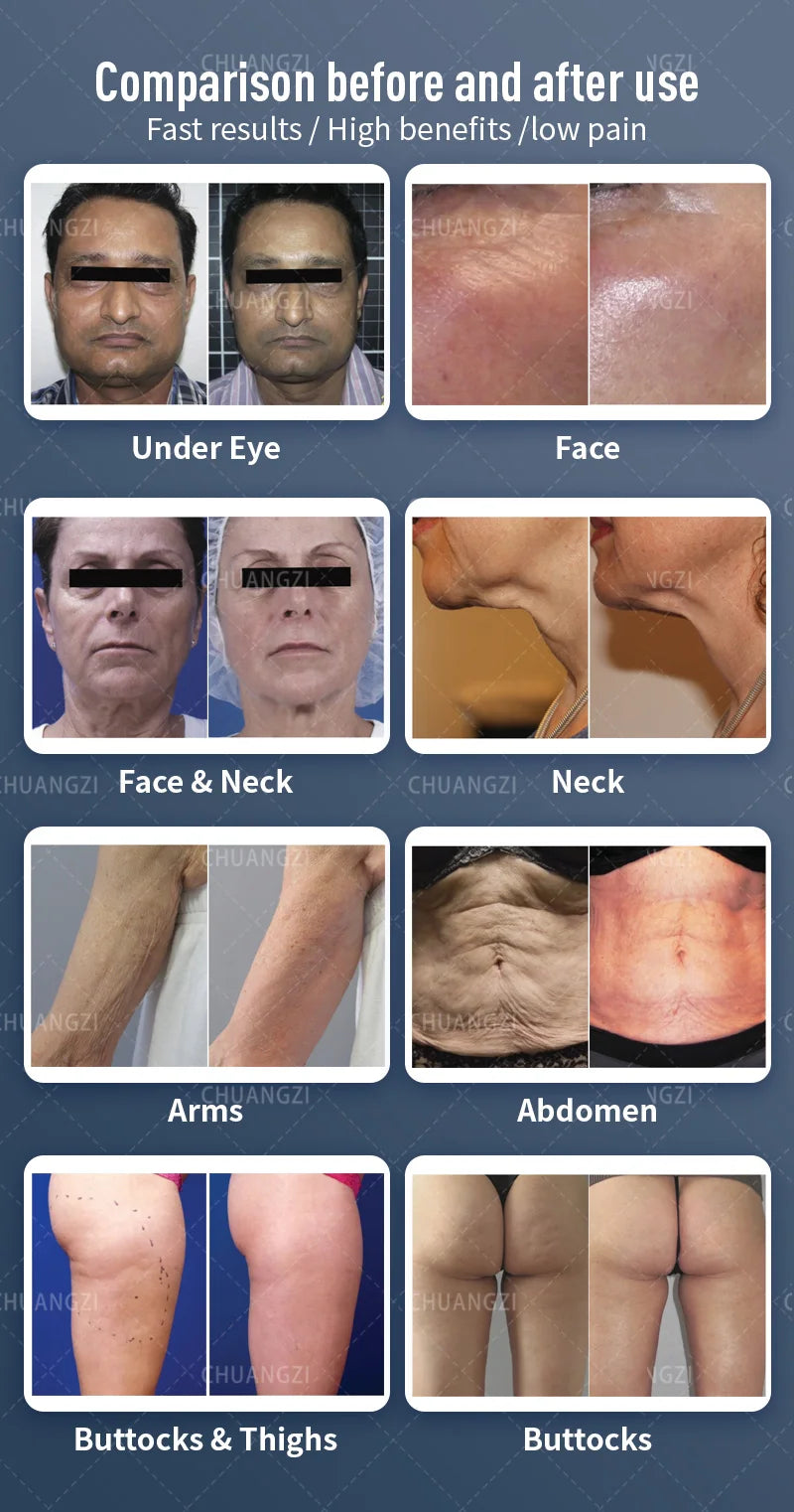 EmpowerEase Venus Legacy Cavitation & RF Body Contouring System