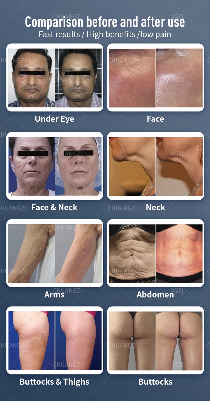 EmpowerEase Venus Legacy Cavitation & RF Body Contouring System