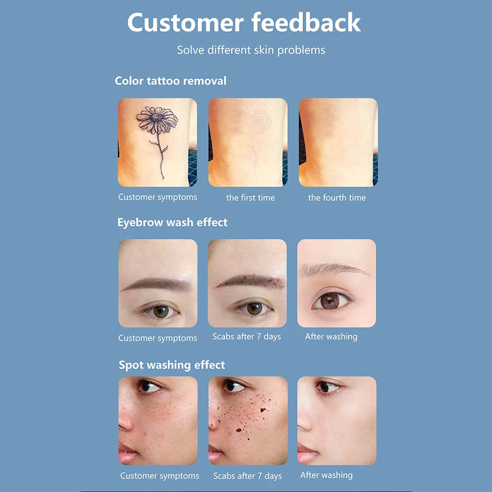 Radiance Renew Laser Precision System