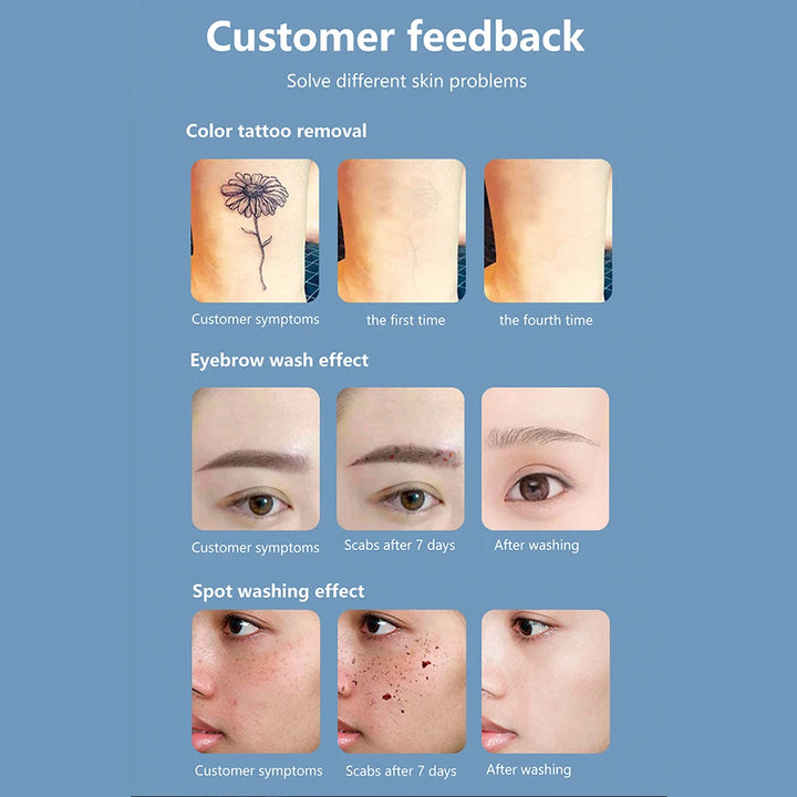 Radiance Renew Laser Precision System