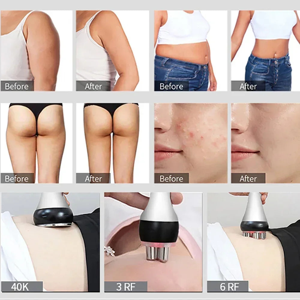 40K Ultrasonic Cavitation & RF EMS Machine – Body Slimming, Facial Lifting & Skin Tightening Beauty Device