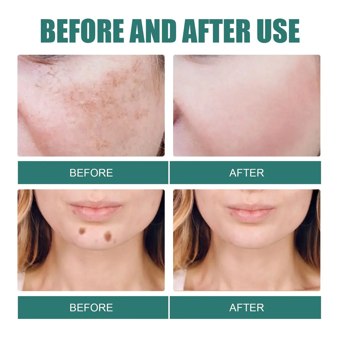 EELHOE Niacinamide Brightening Cream – Fade Melasma, Dark Spots & Fine Lines