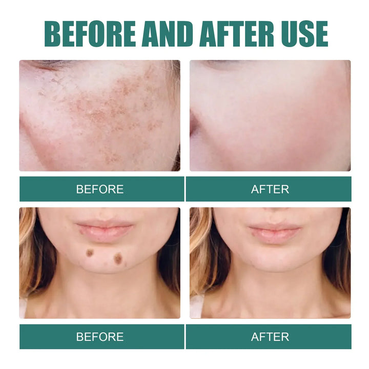 EELHOE Niacinamide Brightening Cream – Fade Melasma, Dark Spots & Fine Lines