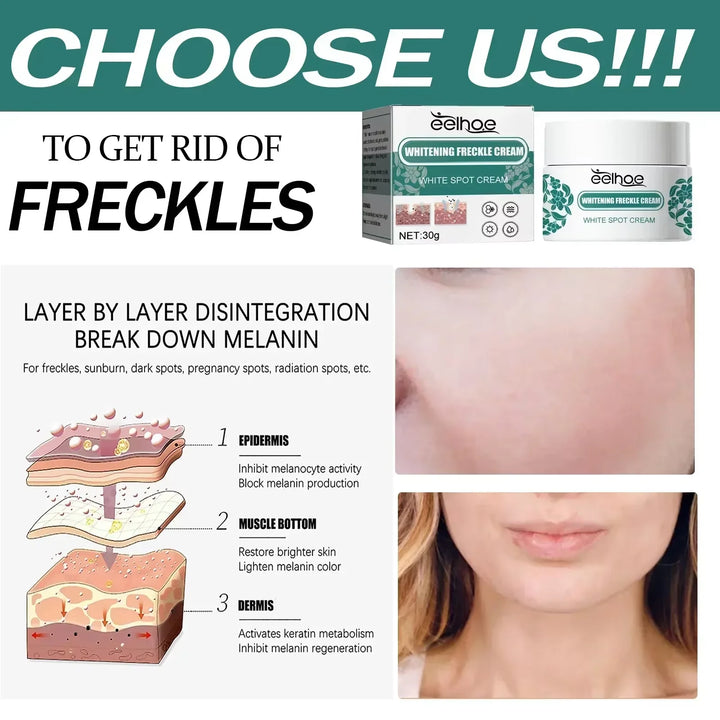 EELHOE Niacinamide Melasma Brightening Cream – Fade Freckles, Dark Spots & Uneven Tone